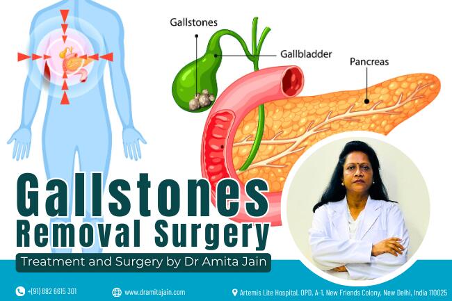 best gallbladder stone removal surgeon Dr Amita Jain.jpg